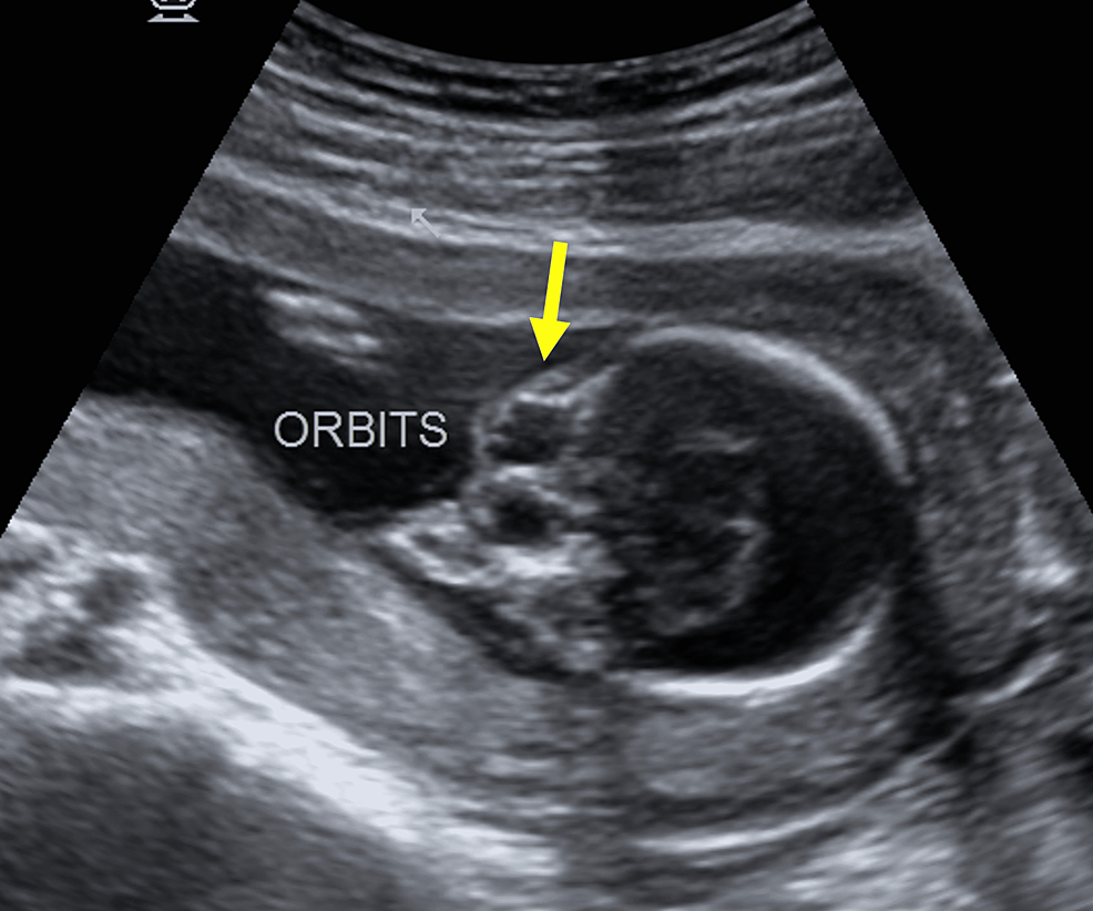 Cureus | Antenatal Ultrasonographic Diagnosis of a Constellation of ...