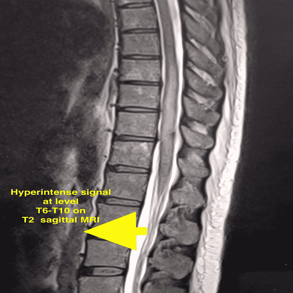 Acute Transverse Myelitis in Pregnancy The Use of ProSeal Laryngeal