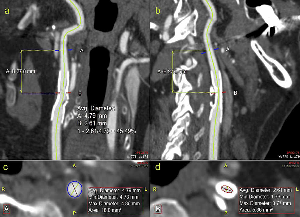 Centerline-reconstruction-of-stented-internal-carotid-artery