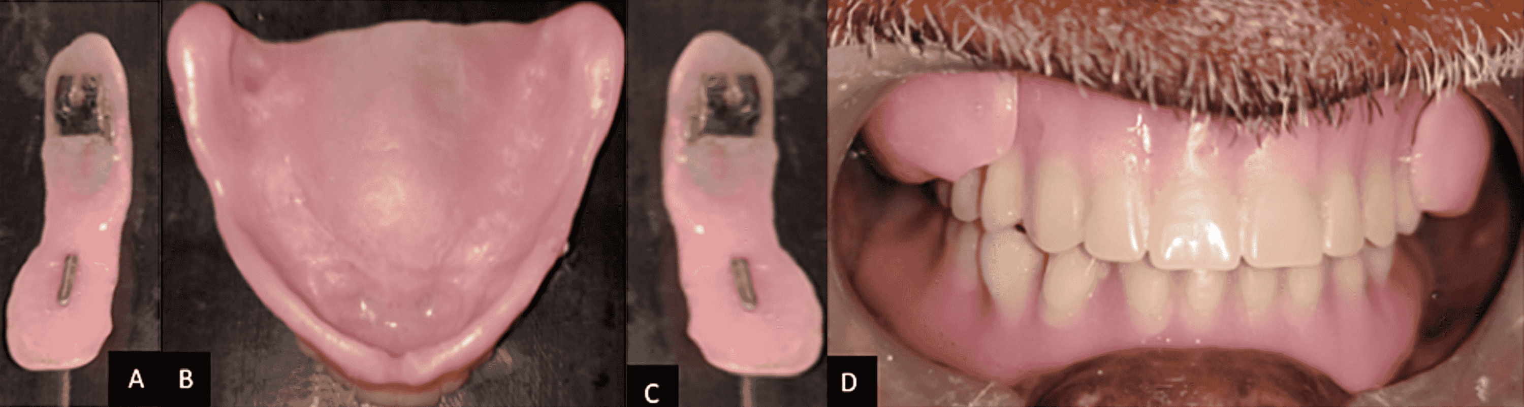 Cureus Enhancing Esthetics in a Complete Denture Patient Optimizing