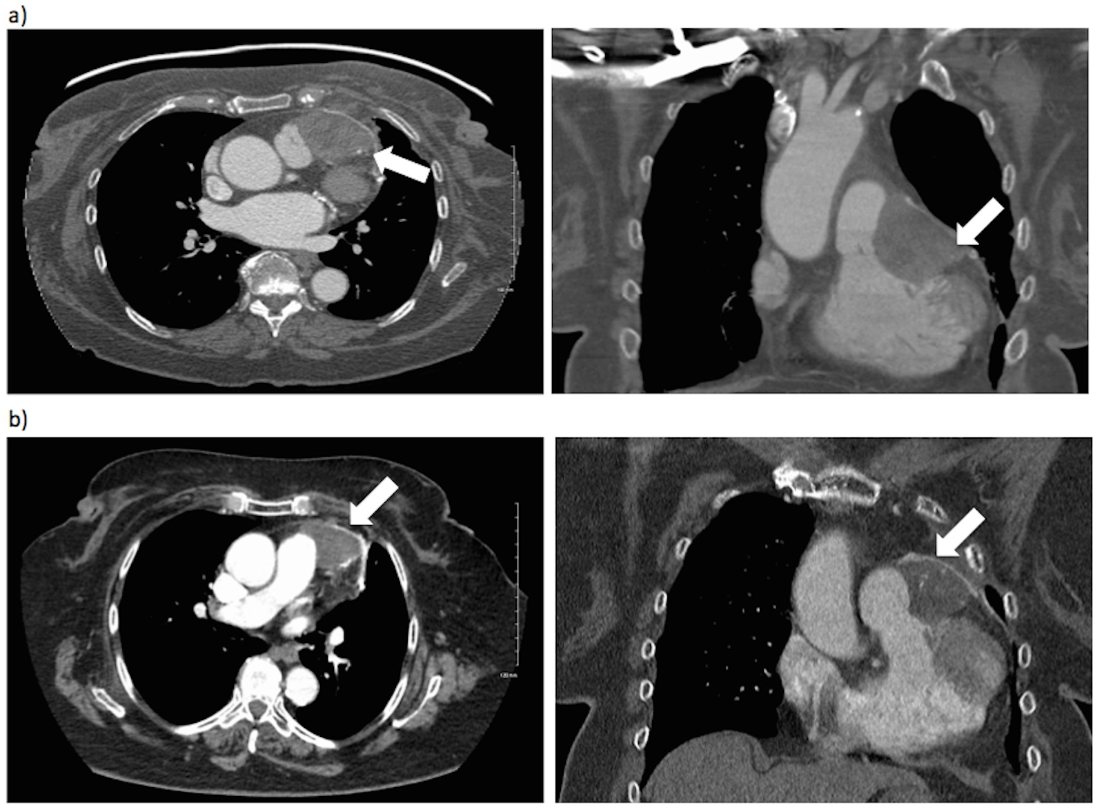 (PDF) pericardial involvement. - · PDF fileUndifferentiated Pleomorphic ...