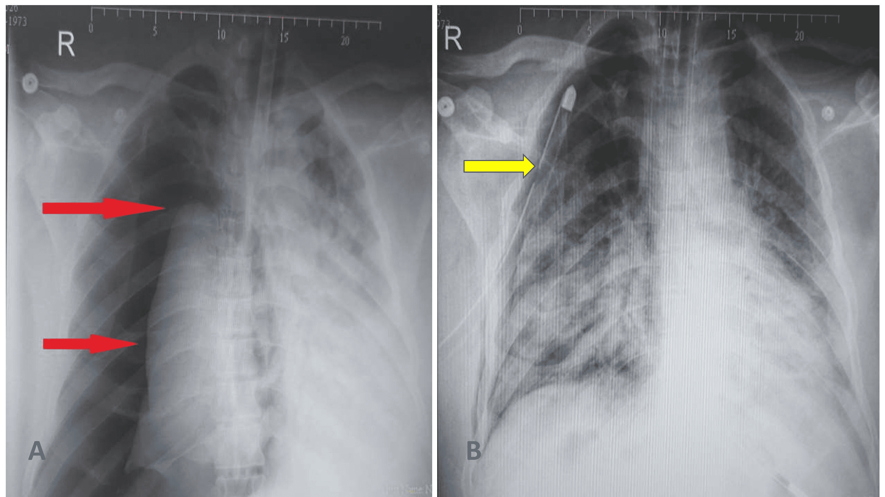 Cureus Pulmonary Barotrauma in COVID19 Patients Experience From a Secondary Care Hospital in