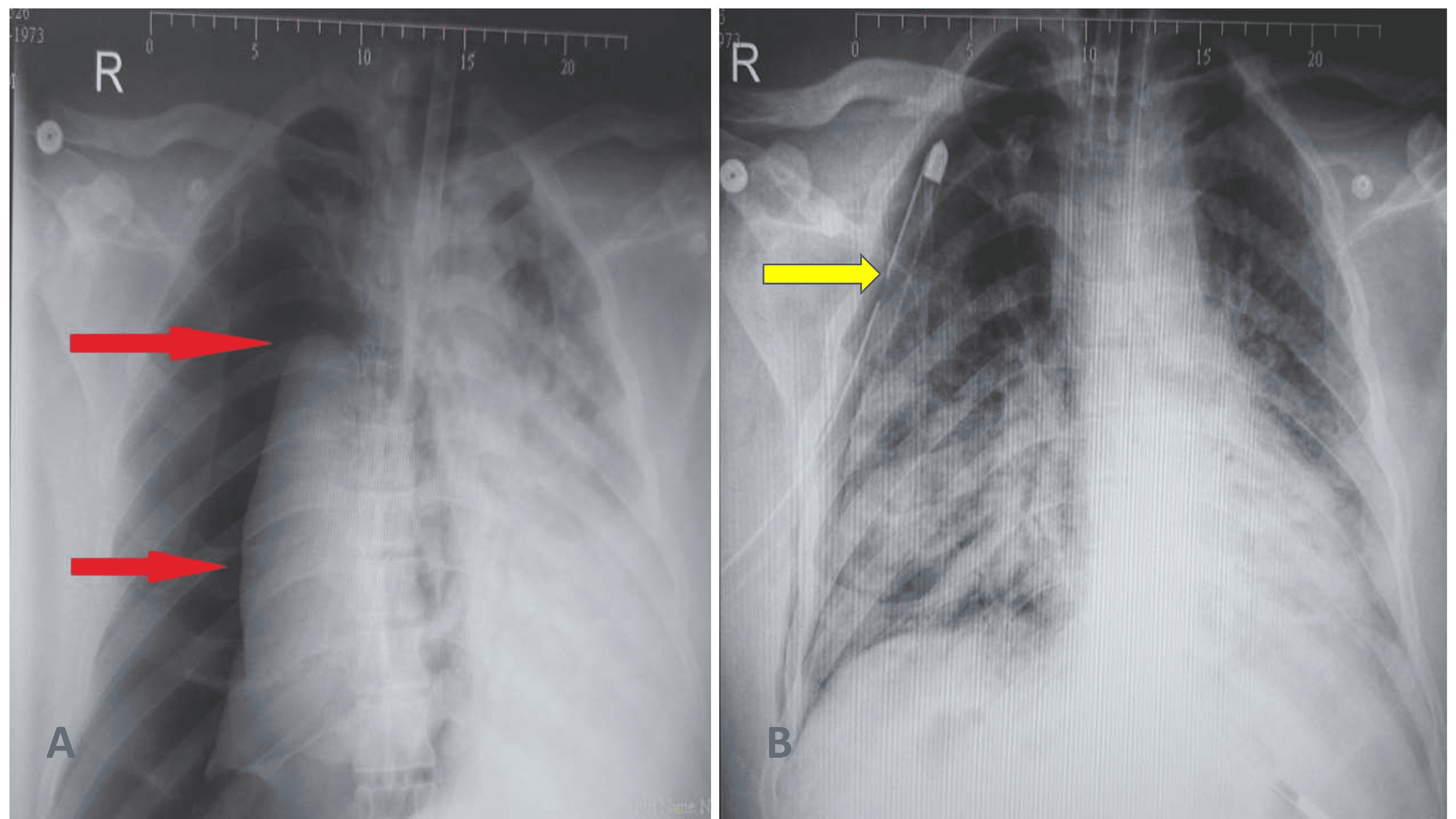 pulmonary barotrauma icd 10
