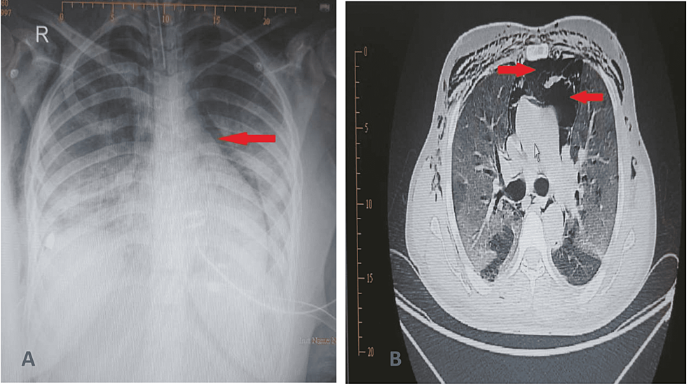 Pulmonary Barotrauma in COVID19 Patients Experience From a Secondary Care Hospital in Oman