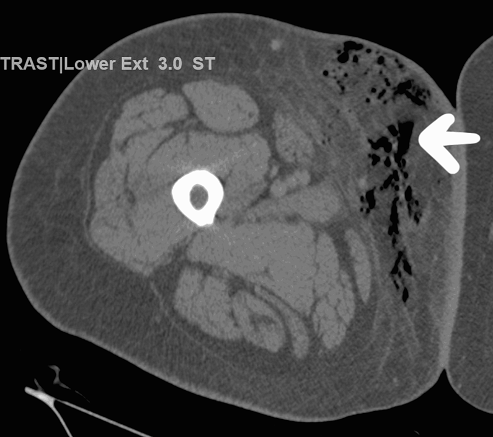 Computed-tomography-(CT)-of--the-right-lower-extremity-revealed-punctate-bubbles-of-gas-in-the-subcutaneous-tissue-in-the-pelvis-which-extended-to-the-medial-right-thigh-consistent-with-NF-(-arrow-marked-area-on-the-image)-