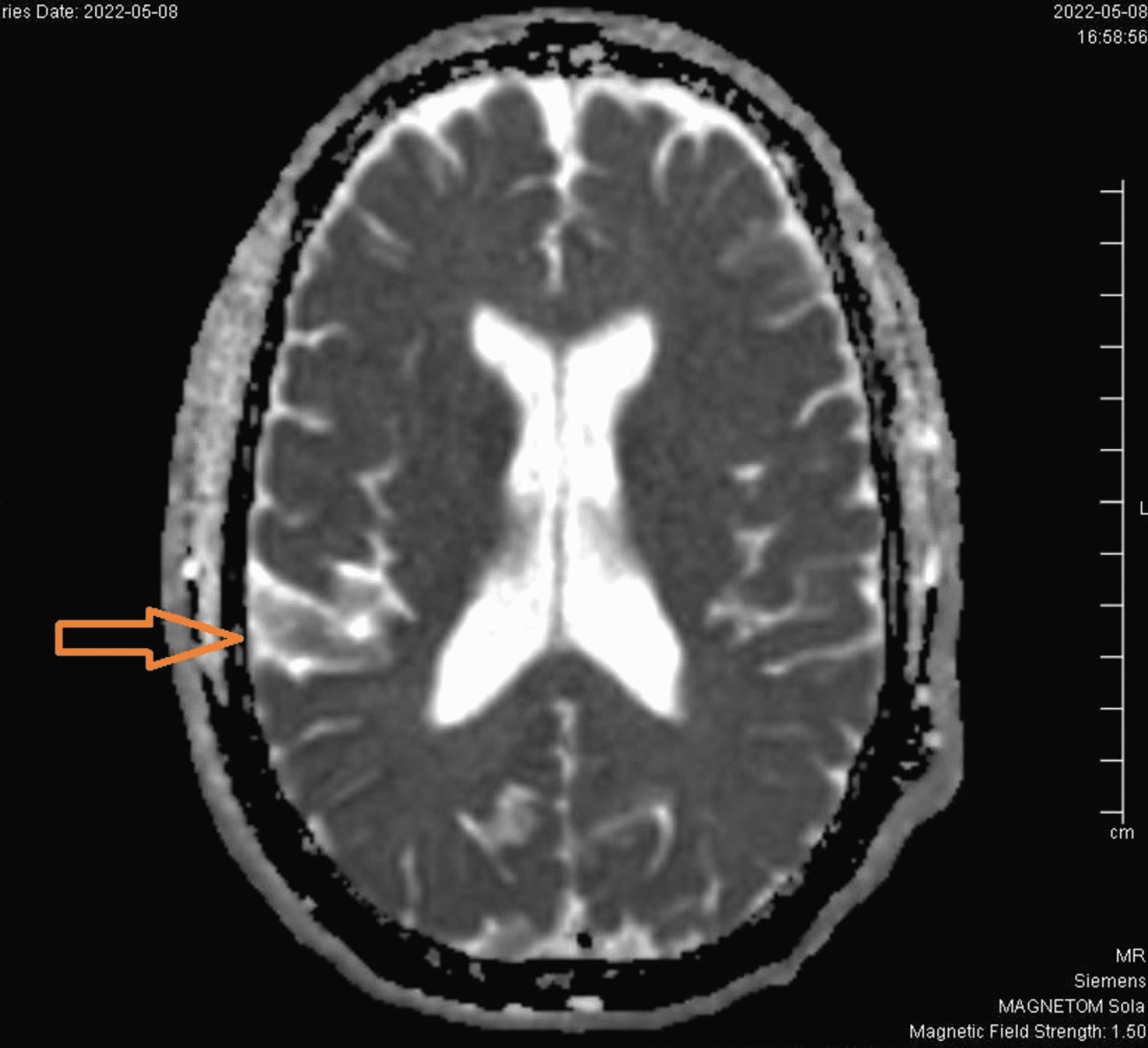 Cureus | Sporadic Creutzfeldt-Jakob Disease in a Patient With Multiple ...