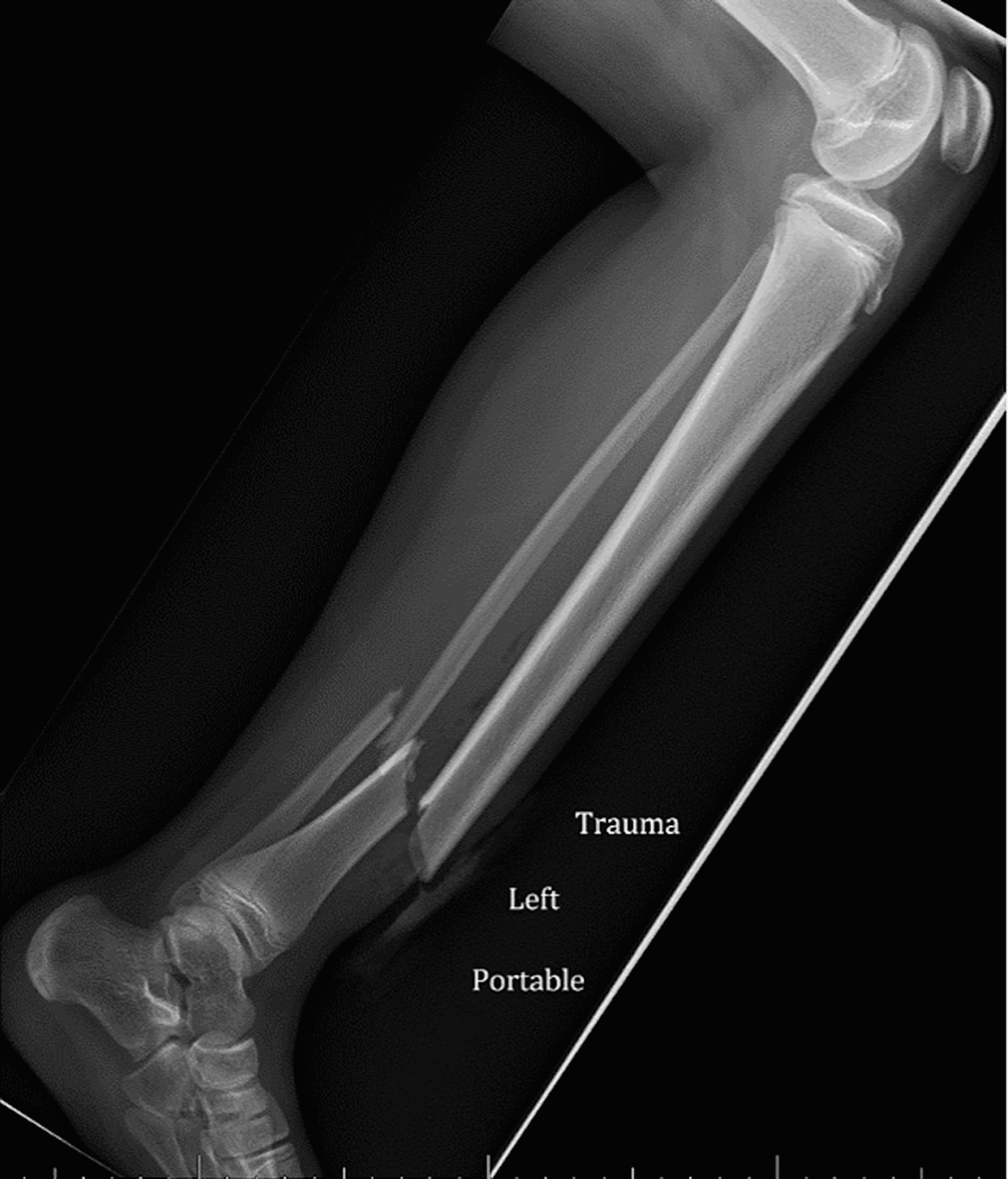 Cureus | Loss of Reduction and Malunion After Cortical Perforation During  Flexible Nailing of an Open Tibia Fracture | Article