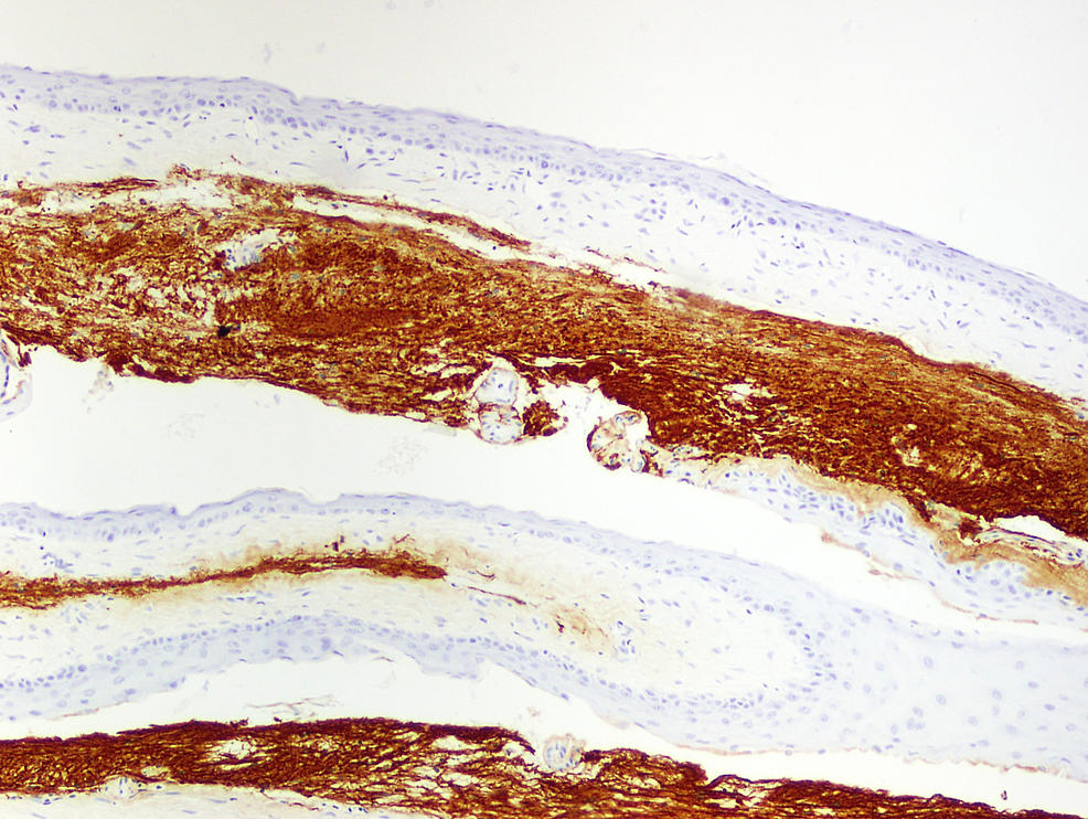 Cureus Suprasellar Epidermoid Cyst Originating From The Infundibulum Case Report And 5269