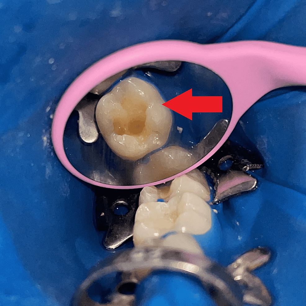 Cureus Stamp Approach for Posterior Composite Restorations A Case Report