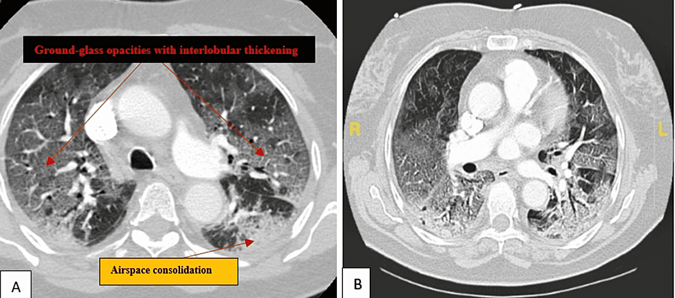 Radiological Finding of Crazy-Paving Pattern in COVID-19 Pneumonia