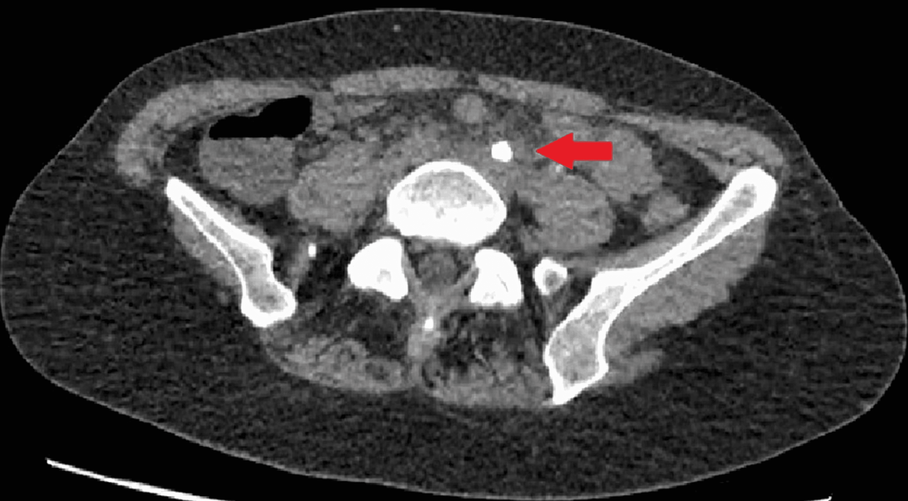 neobladder ultrasound