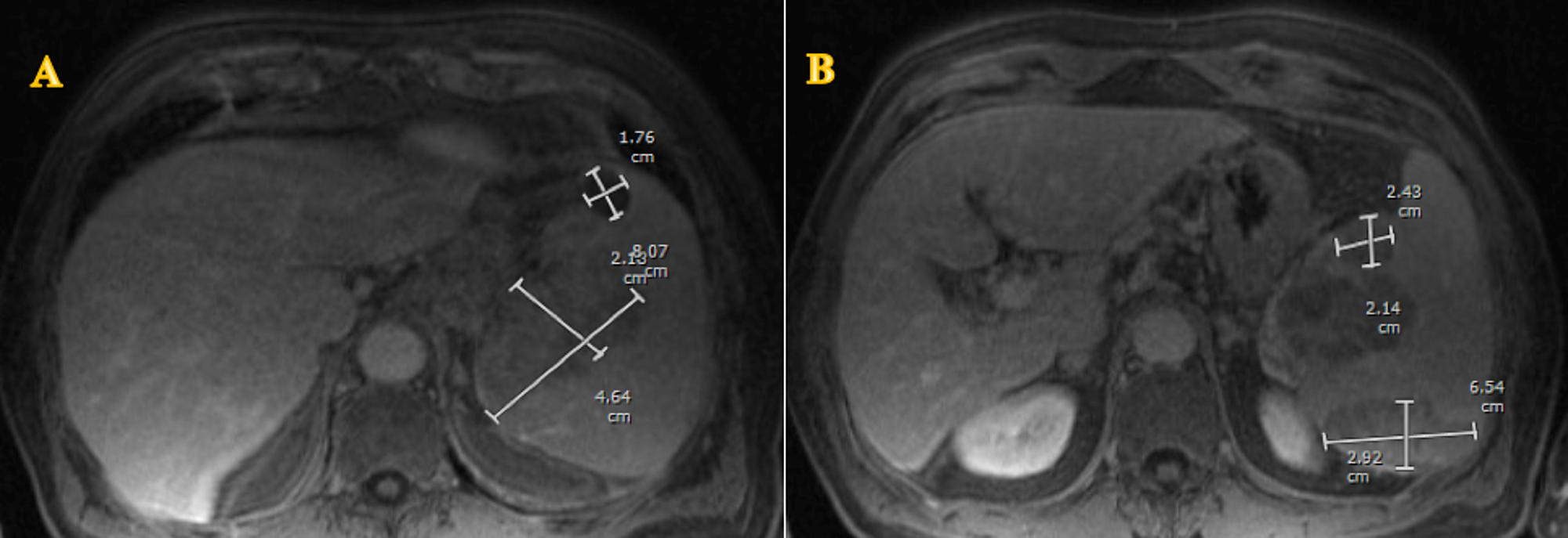 Cureus | Primary Splenic Diffuse Large B-Cell Lymphoma: A Rare Case Of ...