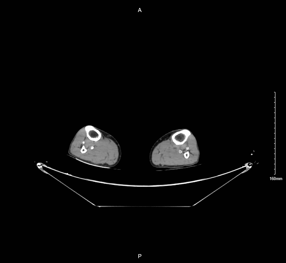 Cureus, A Missed Bilateral, Acute Anterior Exertional Compartment Syndrome  of the Leg