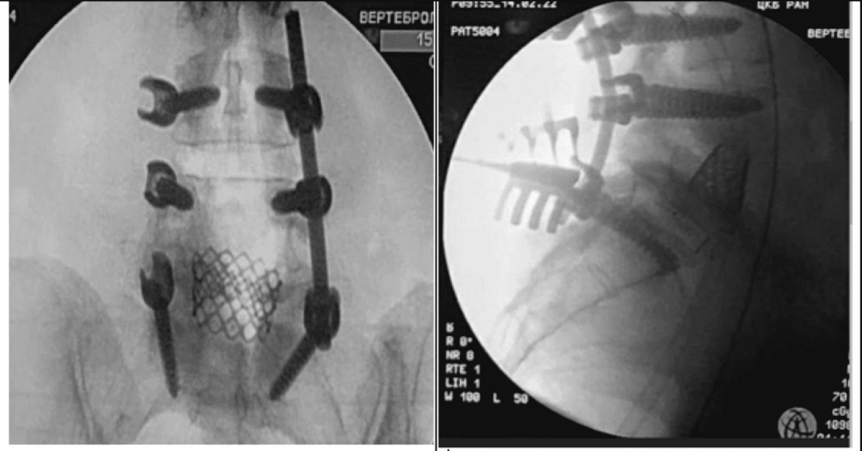 Cureus Surgical Management of Lumbar Hardware Failure Due to