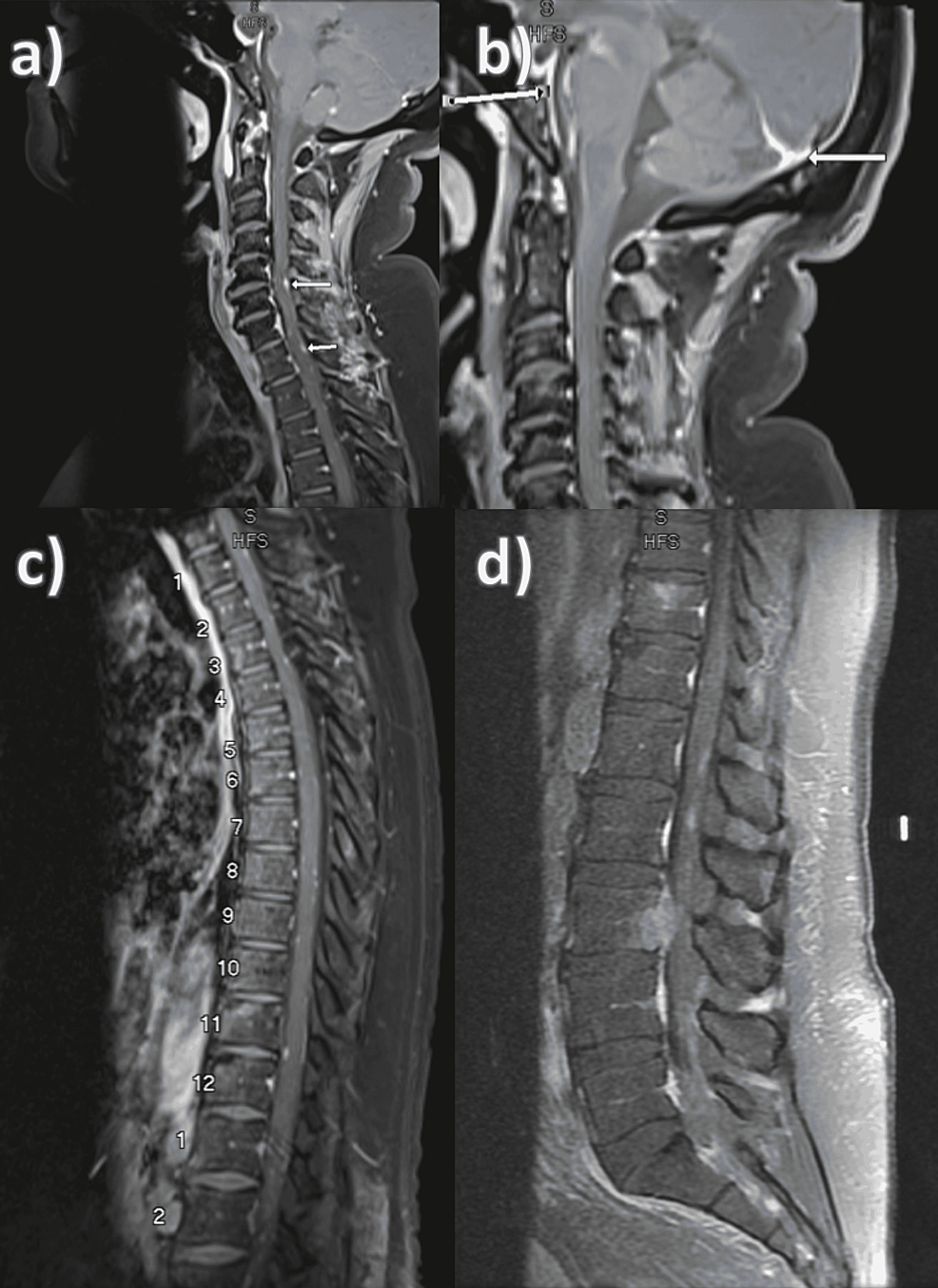 Spine-MRI.