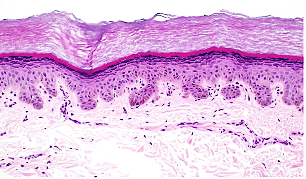 Cureus | Novel Presentation of Reticulate Acropigmentation of Kitamura ...