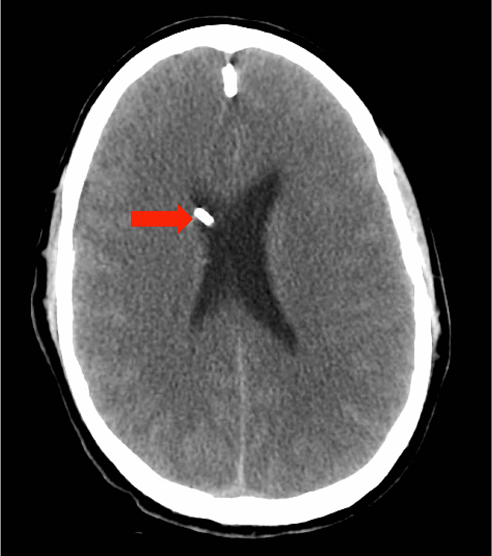Brain MR Imaging in Acute Hyperammonemic Encephalopathy Arising from  Late-Onset Ornithine Transcarbamylase Deficiency | American Journal of  Neuroradiology, image size:986x1114