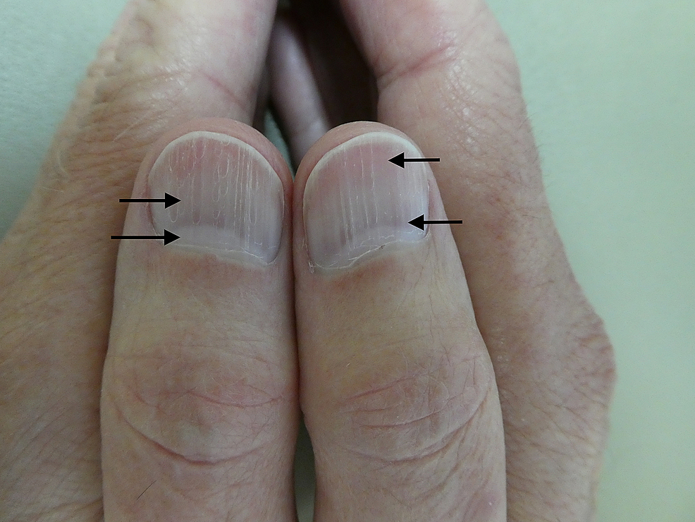 Cureus The Nail Flag Sign Case Report in a Man with Diverticulitis and Review of Dermatology