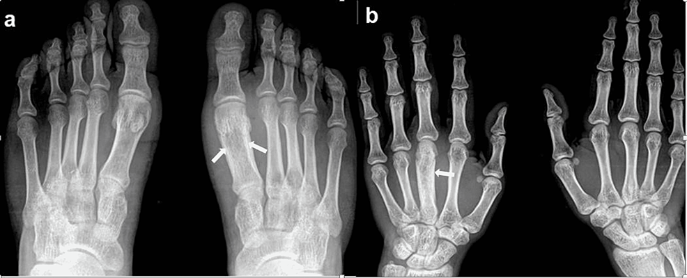 File:X-ray of a normal foot of a 12 year old male - dorsoplantar
