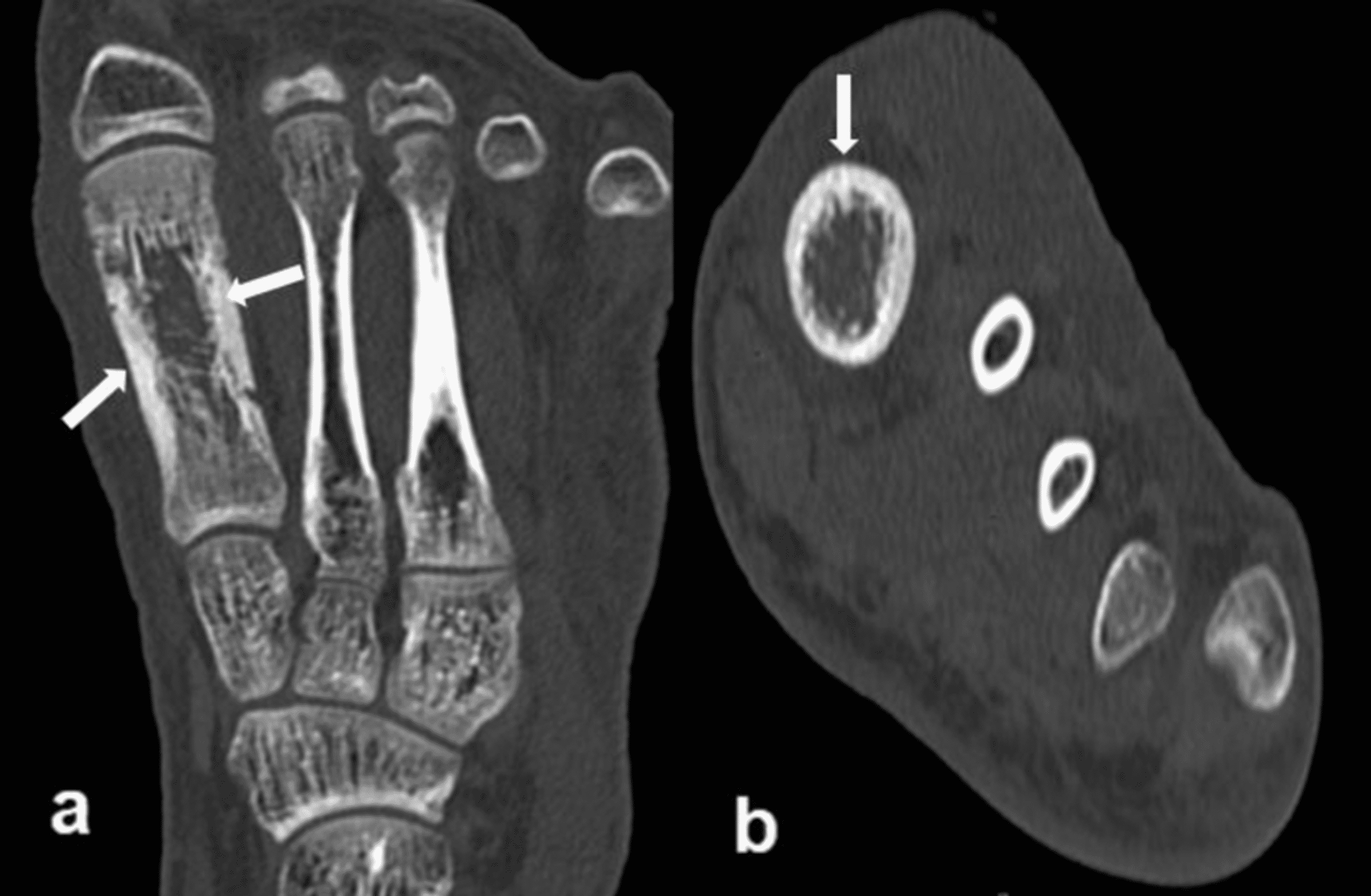 Cureus A Case of Sterile Osteomyelitis Chronic Recurrent Multifocal
