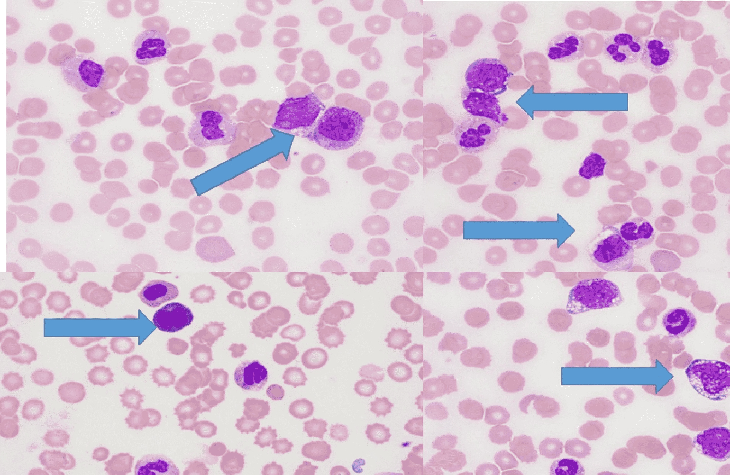 Cureus Cooccurrence of CML Blast Crisis and Severe COVID 19