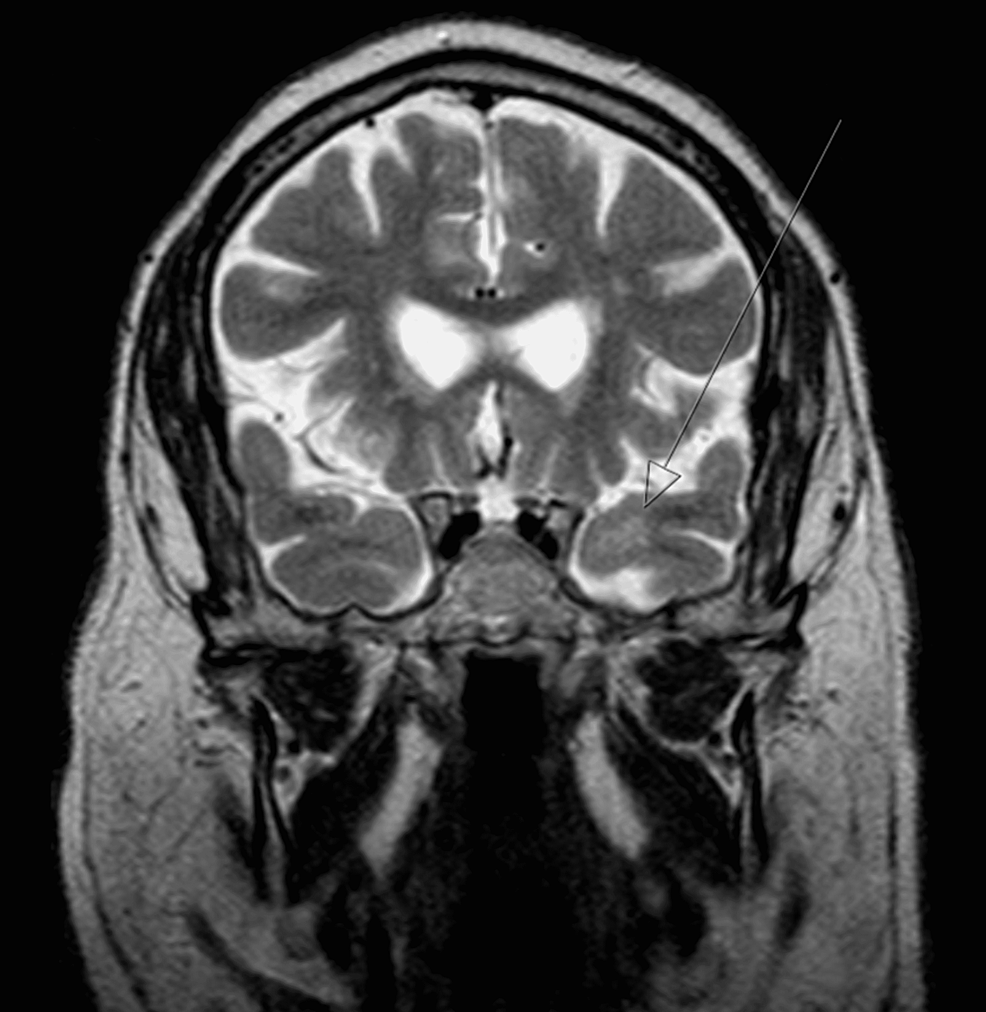 Brain-MRI-coronal-T2-showing-hyperintensity-in-the-left-anterior-temporal-lobe