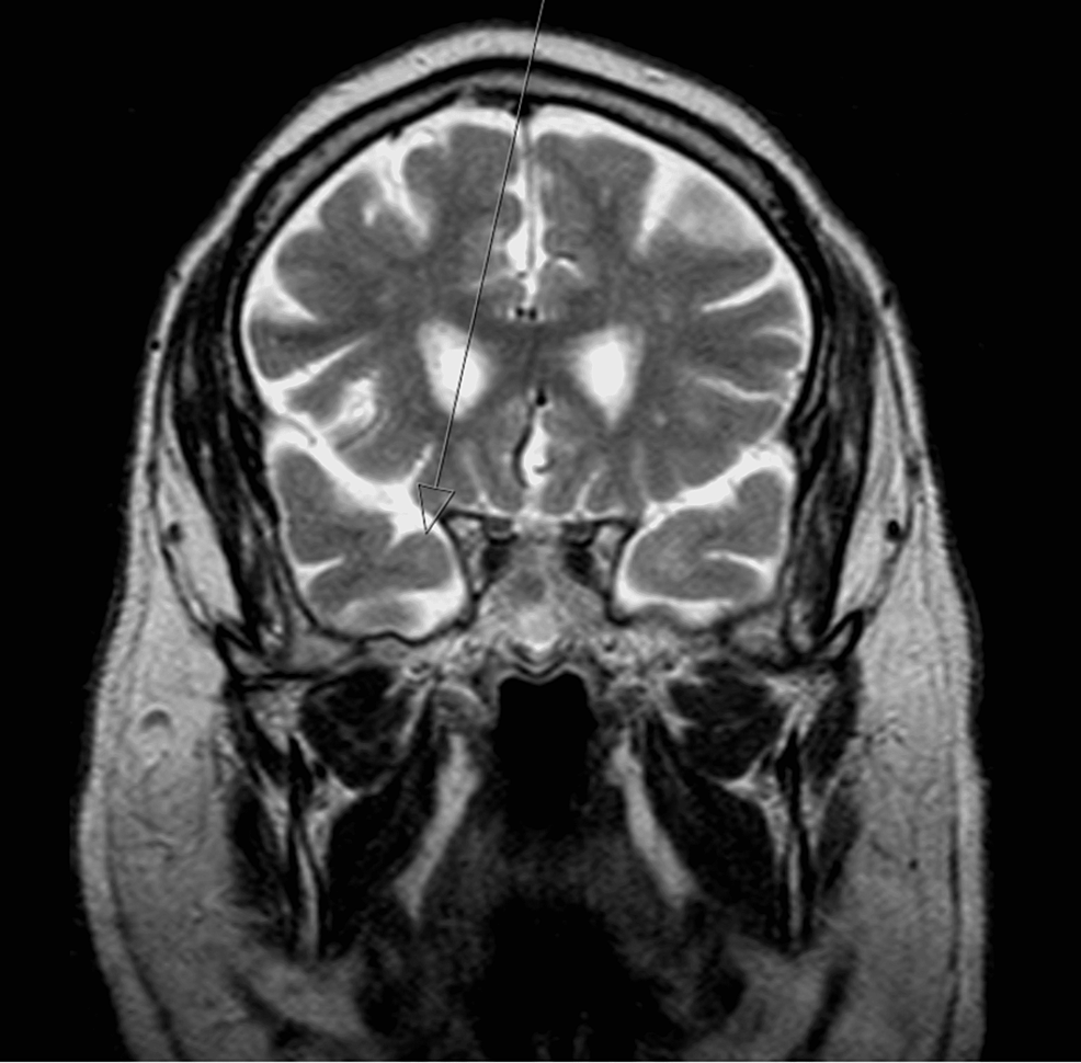 Brain-MRI-coronal-T2-showing-hyperintensity-in-the-right-anterior-temporal-lobe