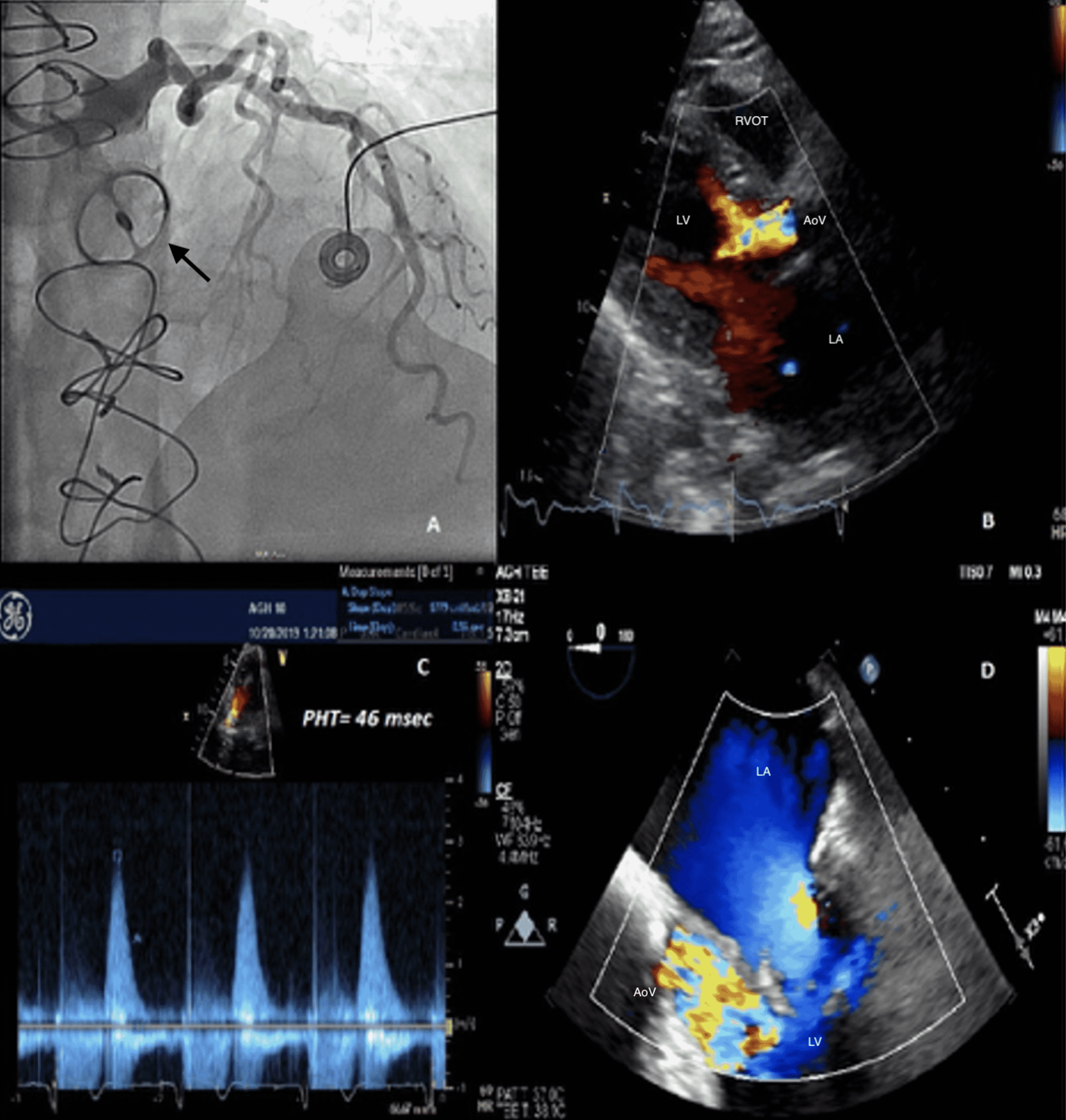 Cureus Acute Severe Aortic Regurgitation From Catastrophic Pannus