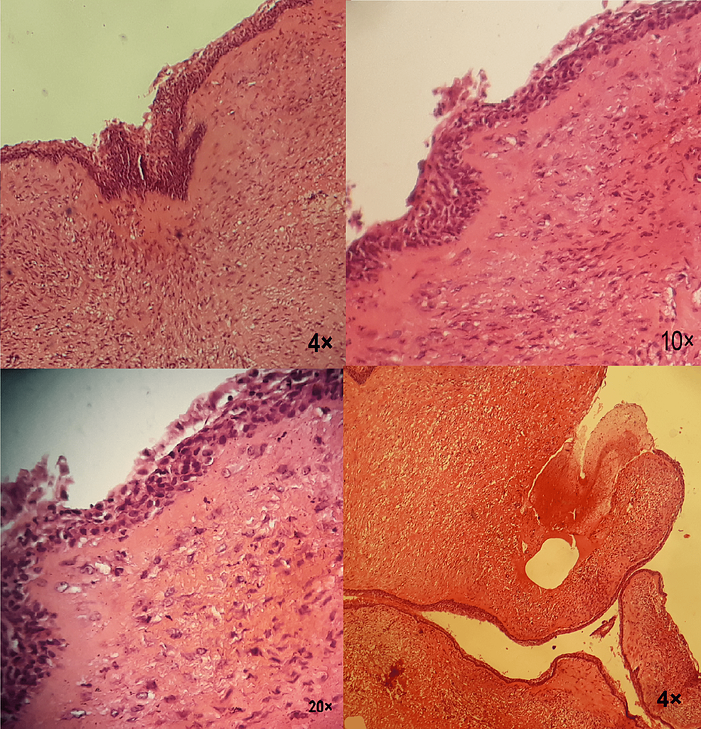 Cureus Marsupialization Of A Large Dentigerous Cyst In The Mandible