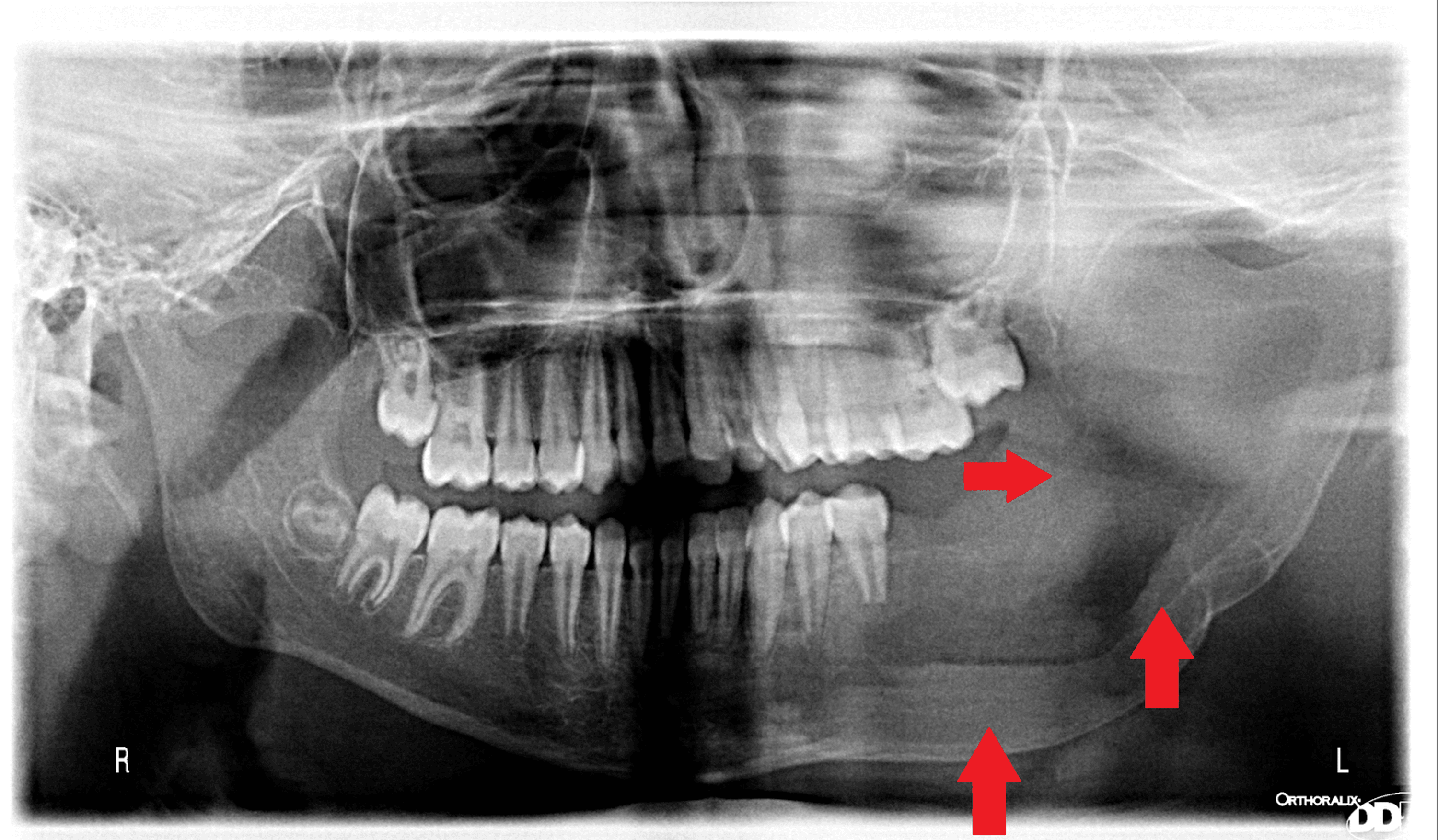 Cureus Marsupialization Of A Large Dentigerous Cyst In The Mandible