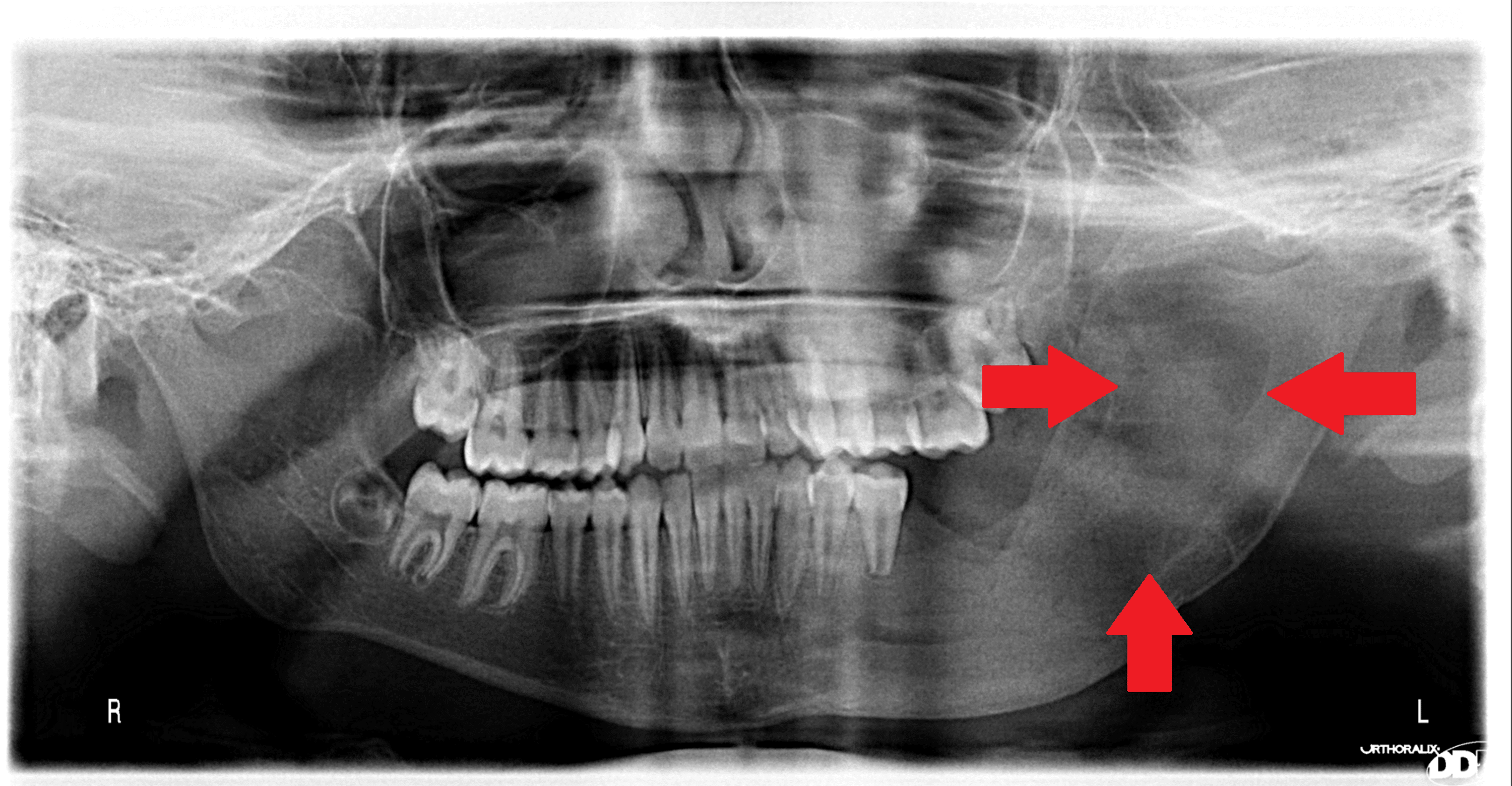 Cureus | Marsupialization of a Large Dentigerous Cyst in the Mandible ...