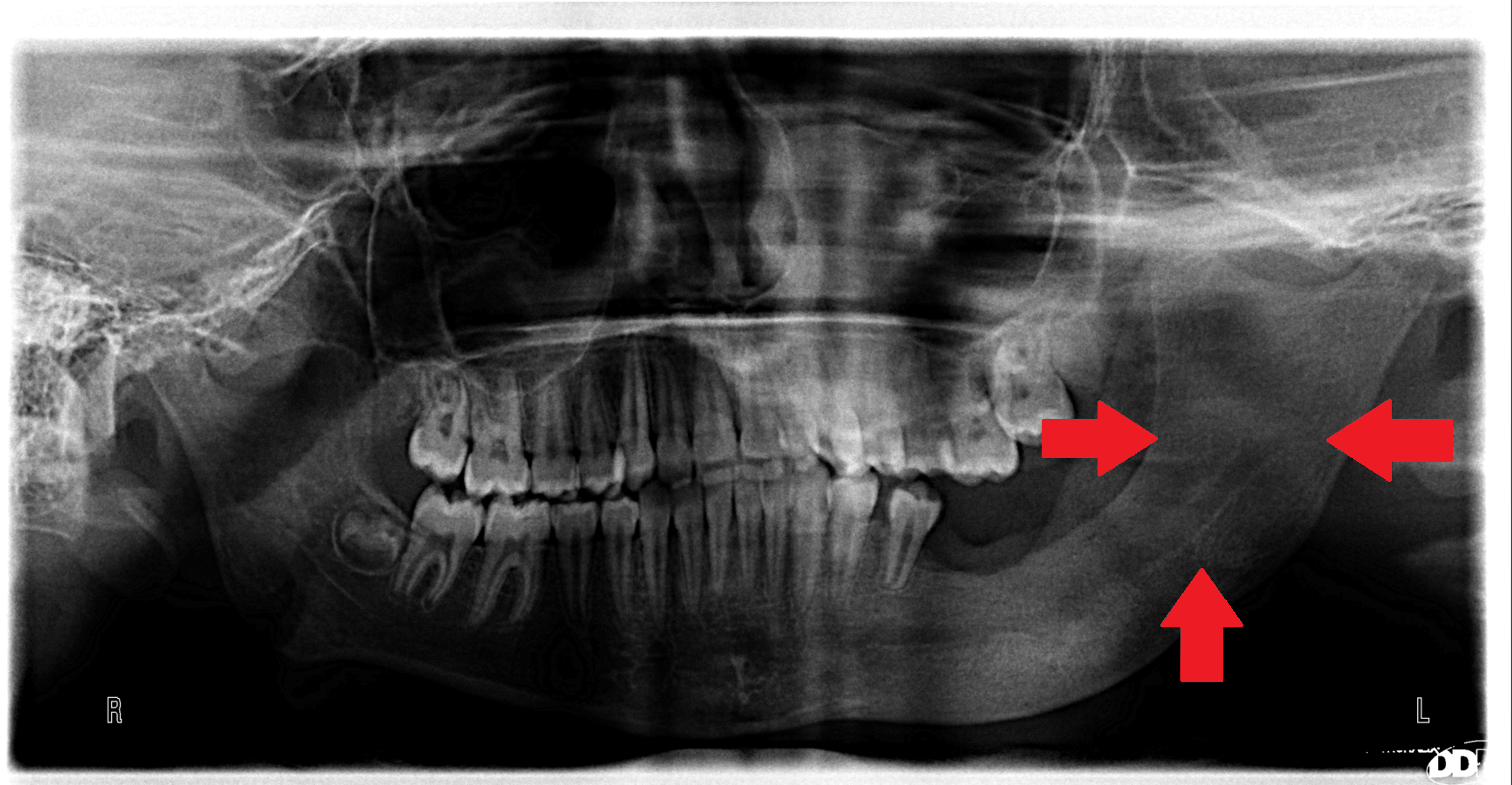 Cureus | Marsupialization of a Large Dentigerous Cyst in the Mandible ...