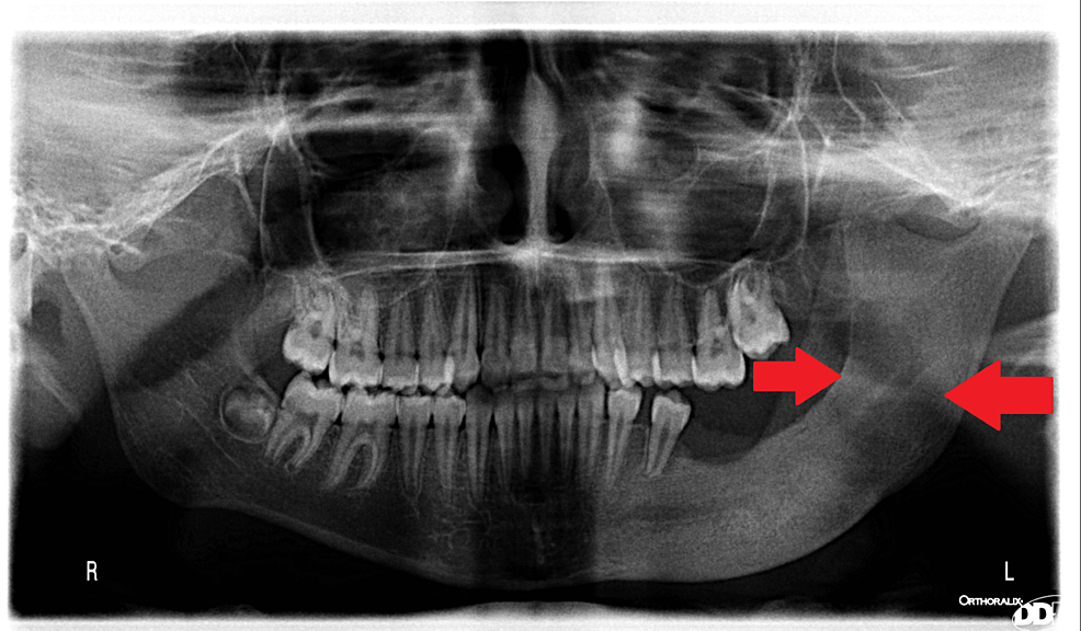 Cureus | Marsupialization of a Large Dentigerous Cyst in the Mandible ...