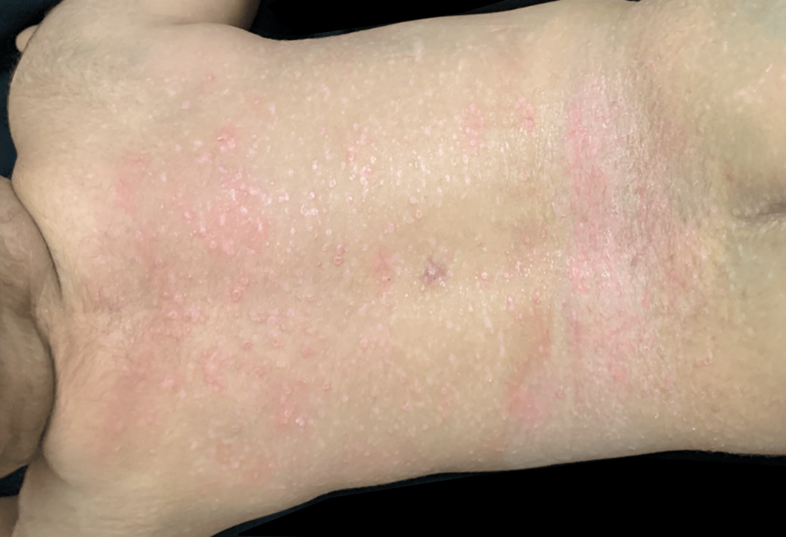 diaper impetigo rash