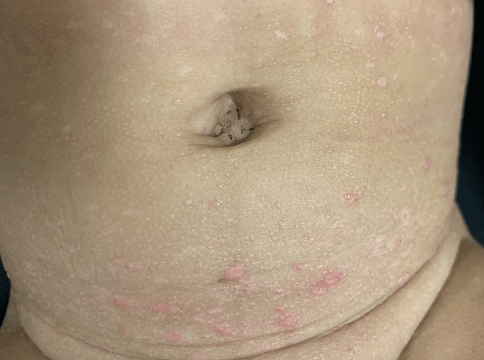 Papules-of-1-2-mm-on-the-lower-abdomen