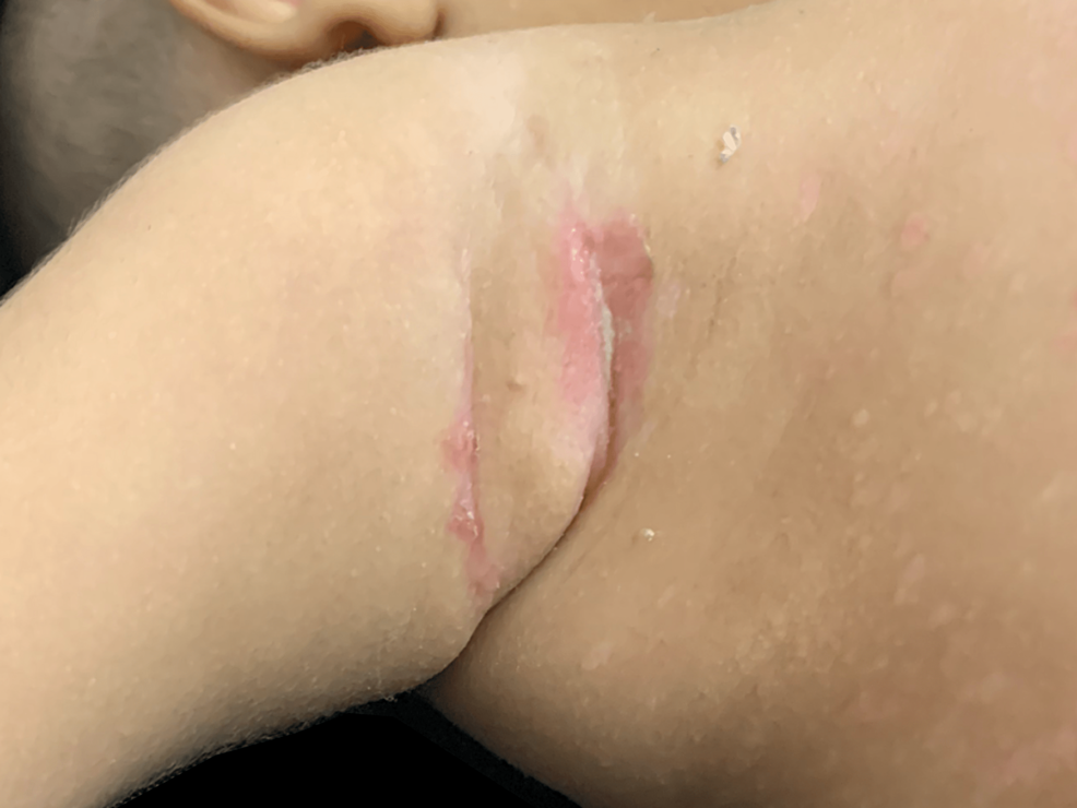 Skin-fissure-on-the-right-axilla