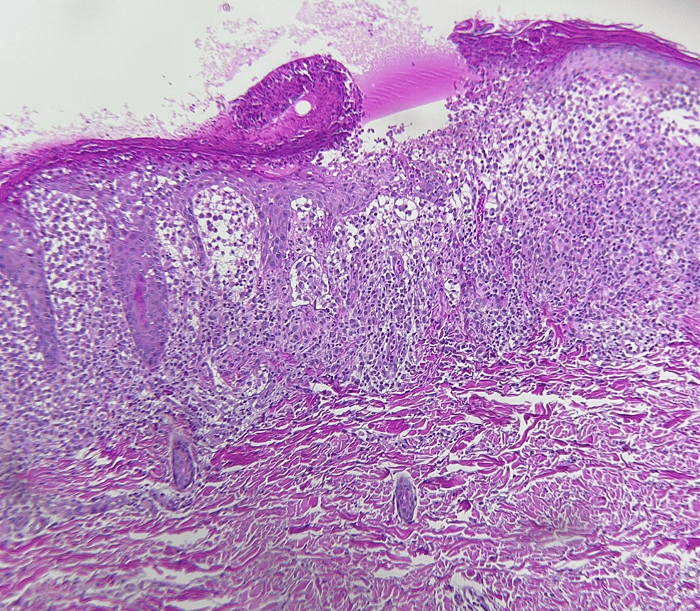 Histological-section-of-the-skin-showing-an-ulcerated-epidermis-and-inflammatory-cell-infiltrate-in-the-dermis-and-epidermis-(hematoxylin-and-eosin,-20x)