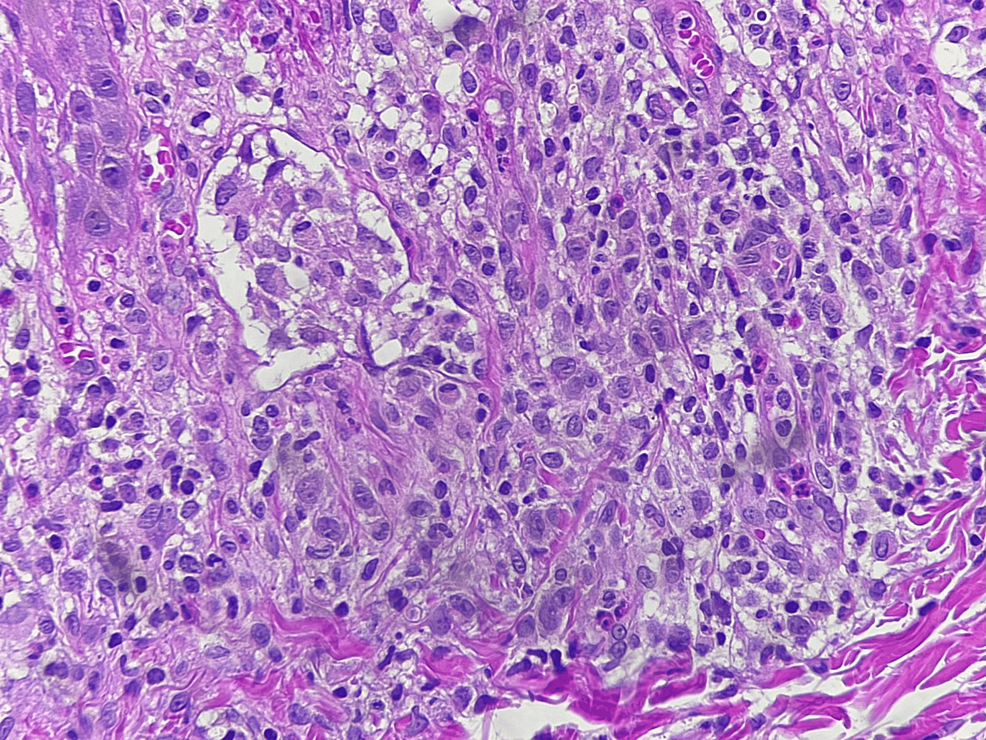 Histological-section-of-the-dermis-showing-infiltration-of-abundant-histiocytes-with-cytoplasmic-vacuolation-and-microabscesses-in-the-dermis-(hematoxylin-and-eosin,-40x)