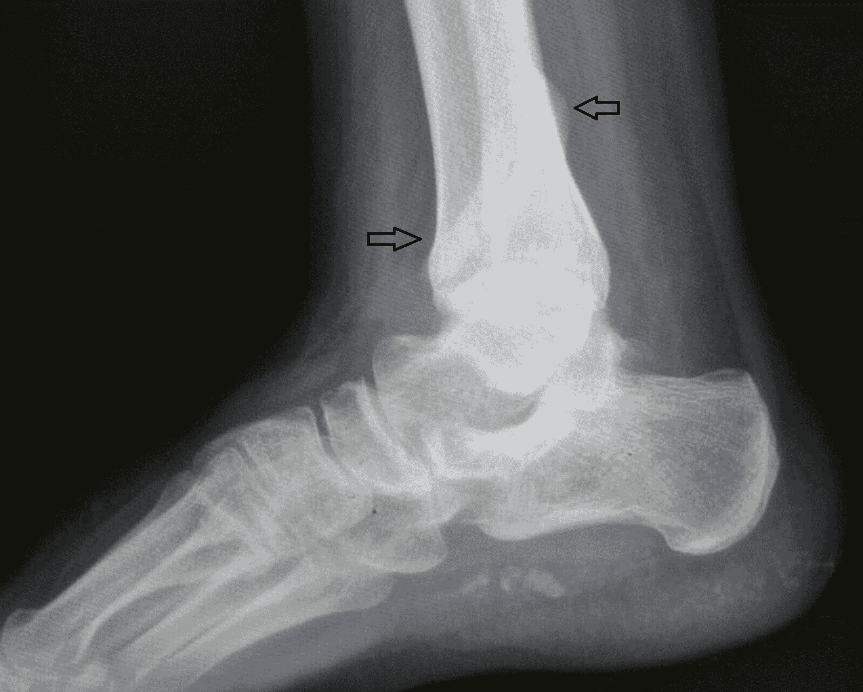 Surgical Intervention in Neglected Ankle Fracture: A Case Report | Cureus