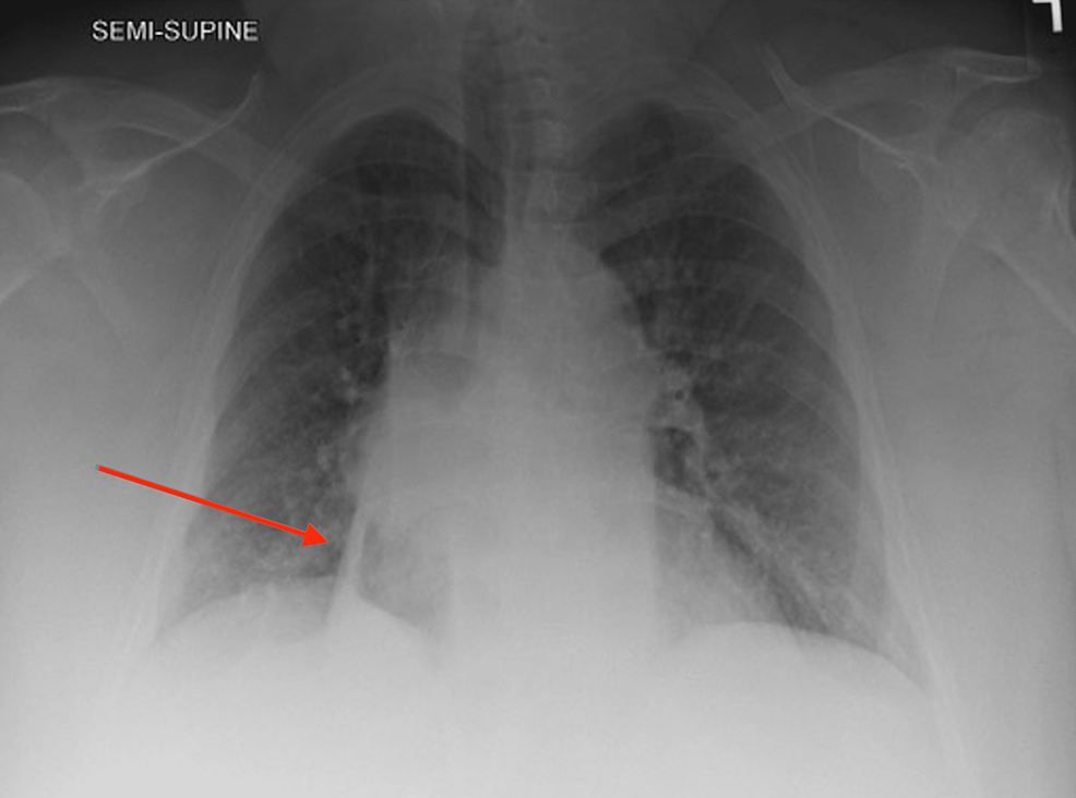 Chest-X-ray-revealing-right-lower-lobe-opacity-concerning-for-lung-mass-(red-arrow)