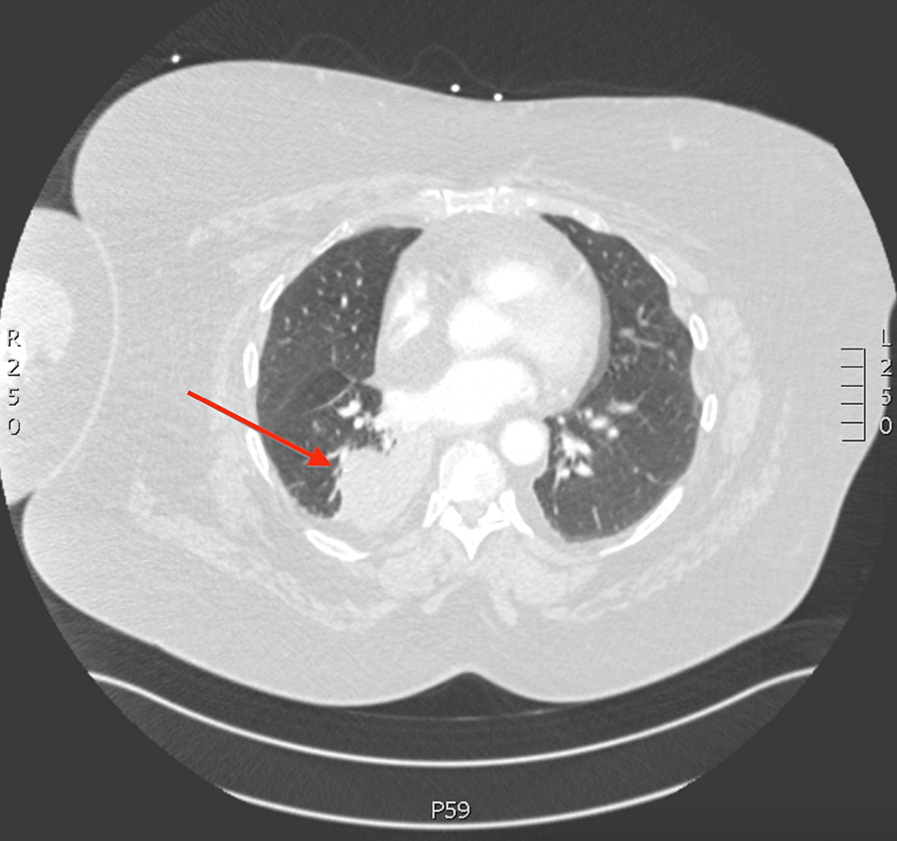 CT-Chest-with-IV-contrast-revealed-atelectatic-lung-surrounding-a-right-peri-mediastinal-mass-(red-arrow)