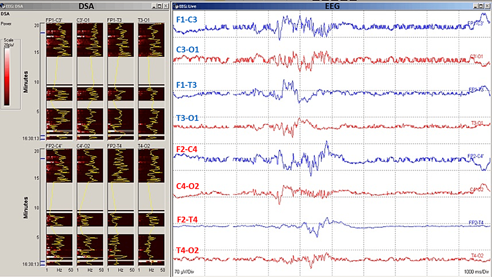 Electroencephalography-(EEG)-data-during-carotid-endarterectomy-(CEA)-surgery.
