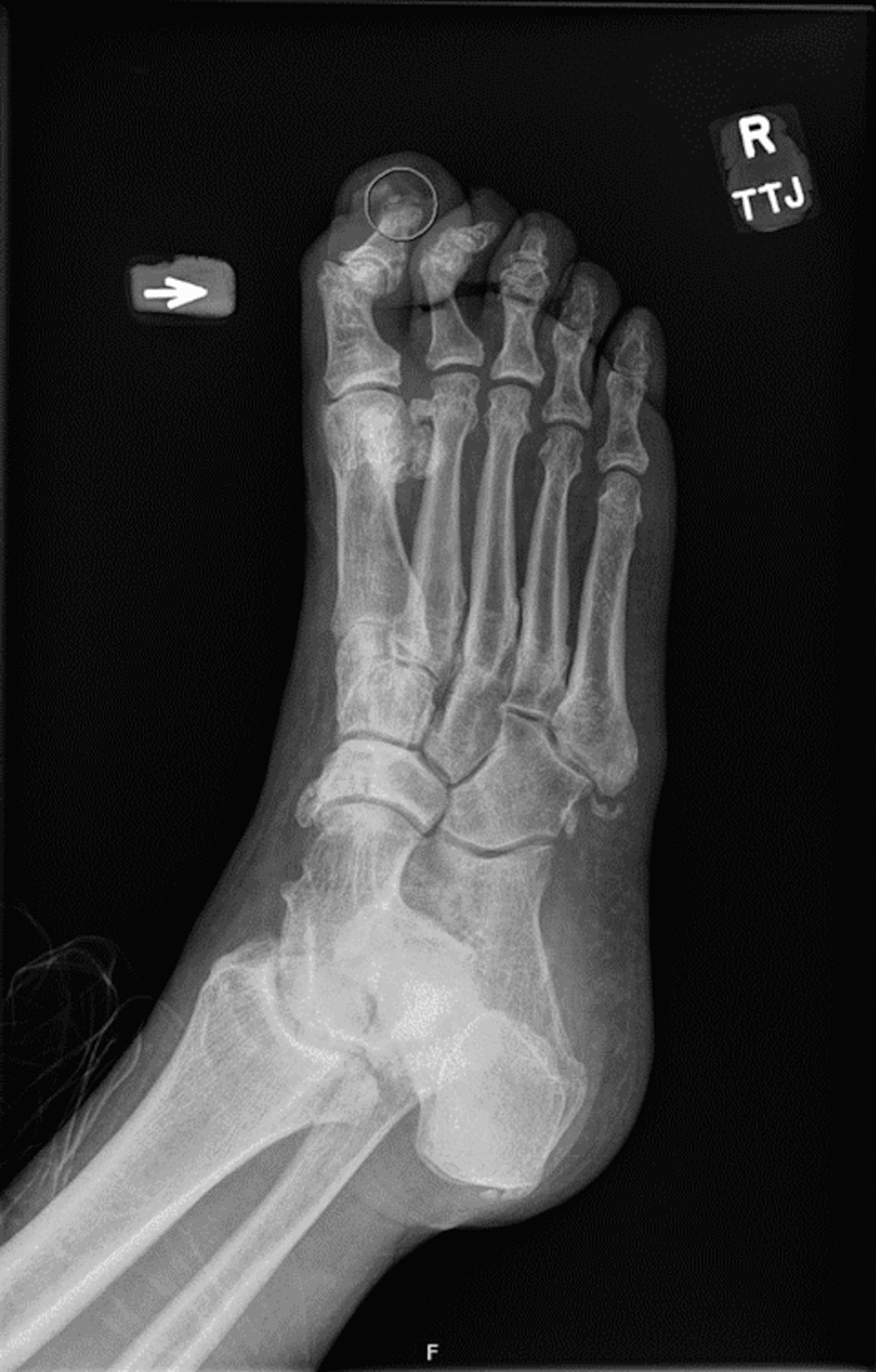 X-ray-of-right-foot-demonstrating-soft-tissue-ulceration-of-the-first-digit-with-fragmentation-at-the-tip-of-the-first-distal-phalanx,-concerning-for-acute-osteomyelitis--