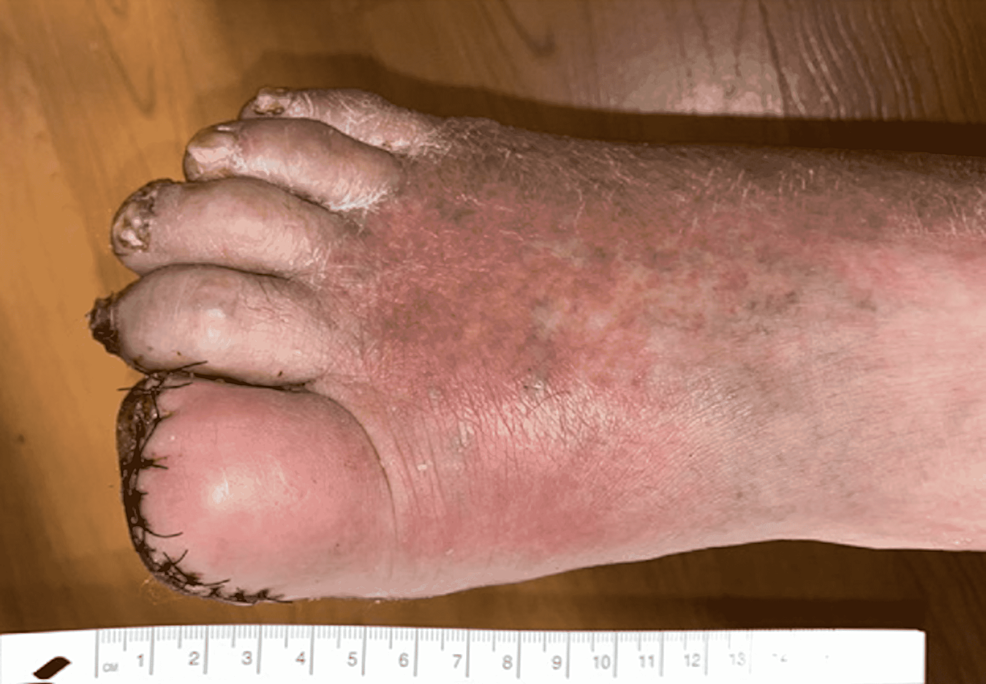 Postoperative-findings-to-the-right-foot-with-sutures-in-place-and-significant-erythema-and-warmth-