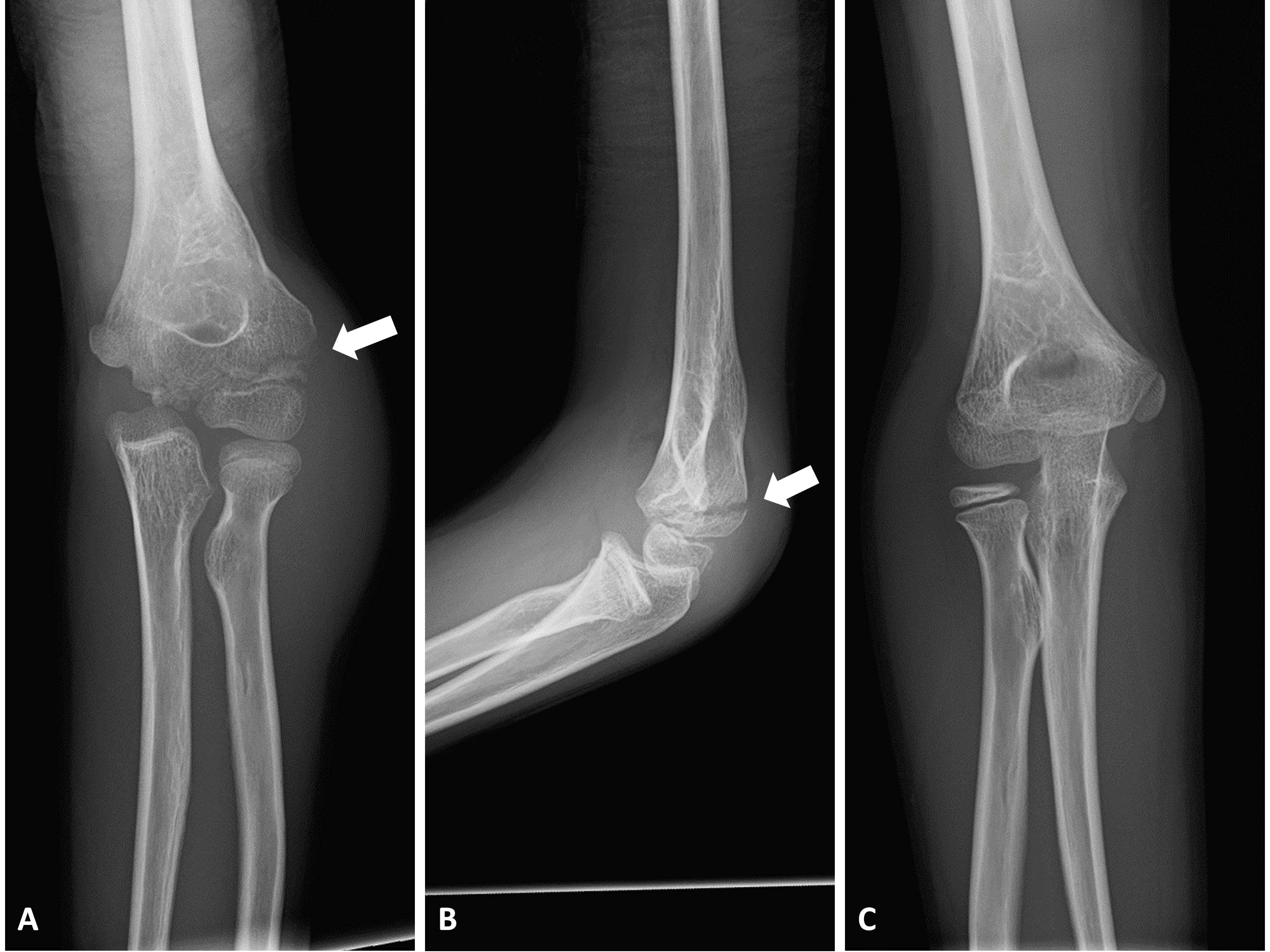 Cureus | Simultaneous Open Reduction And Corrective Osteotomy For A ...