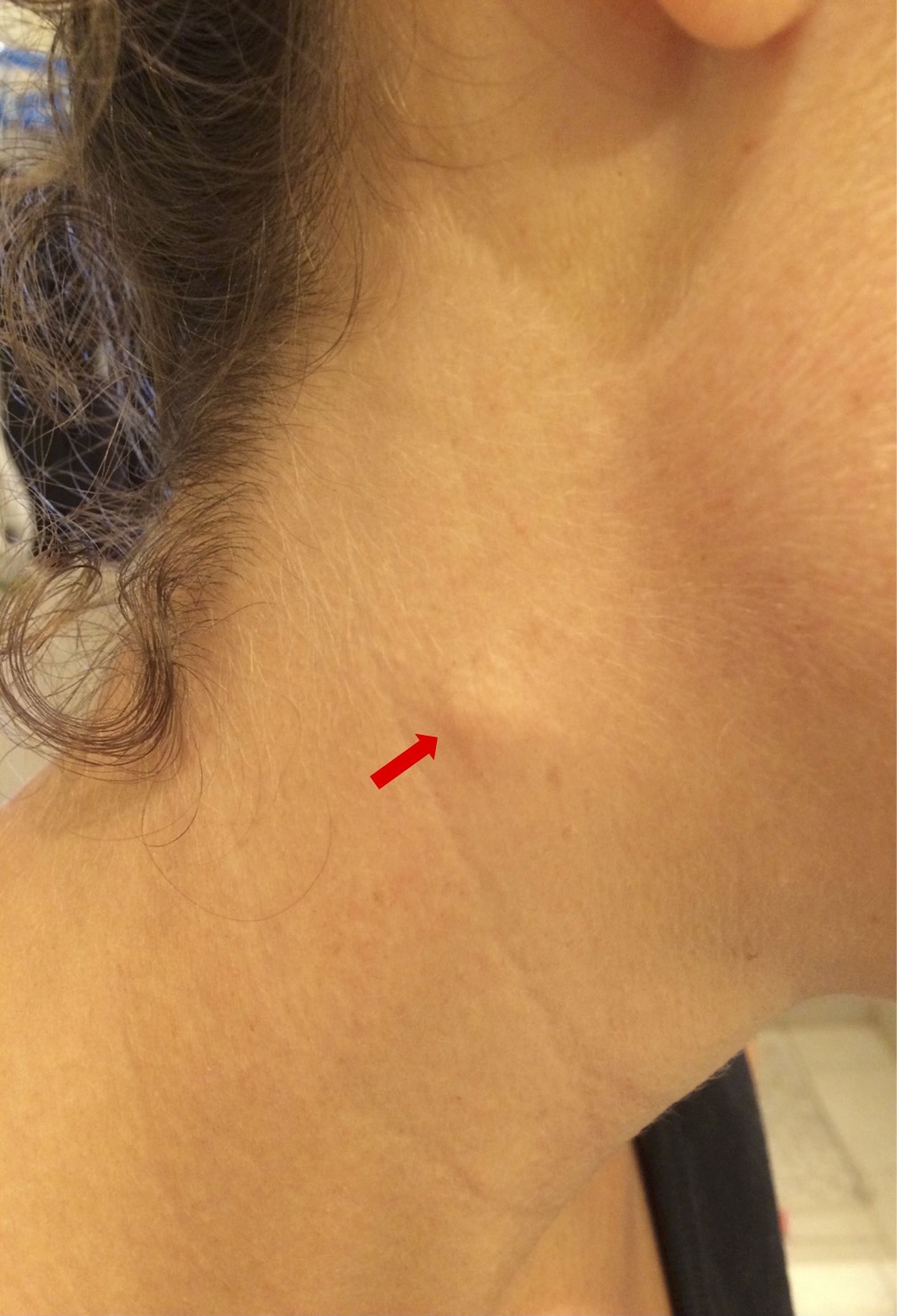 Cervical Lymph Node Swelling On Neck My Xxx Hot Girl