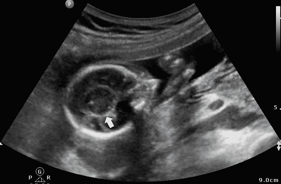anophthalmia ultrasound