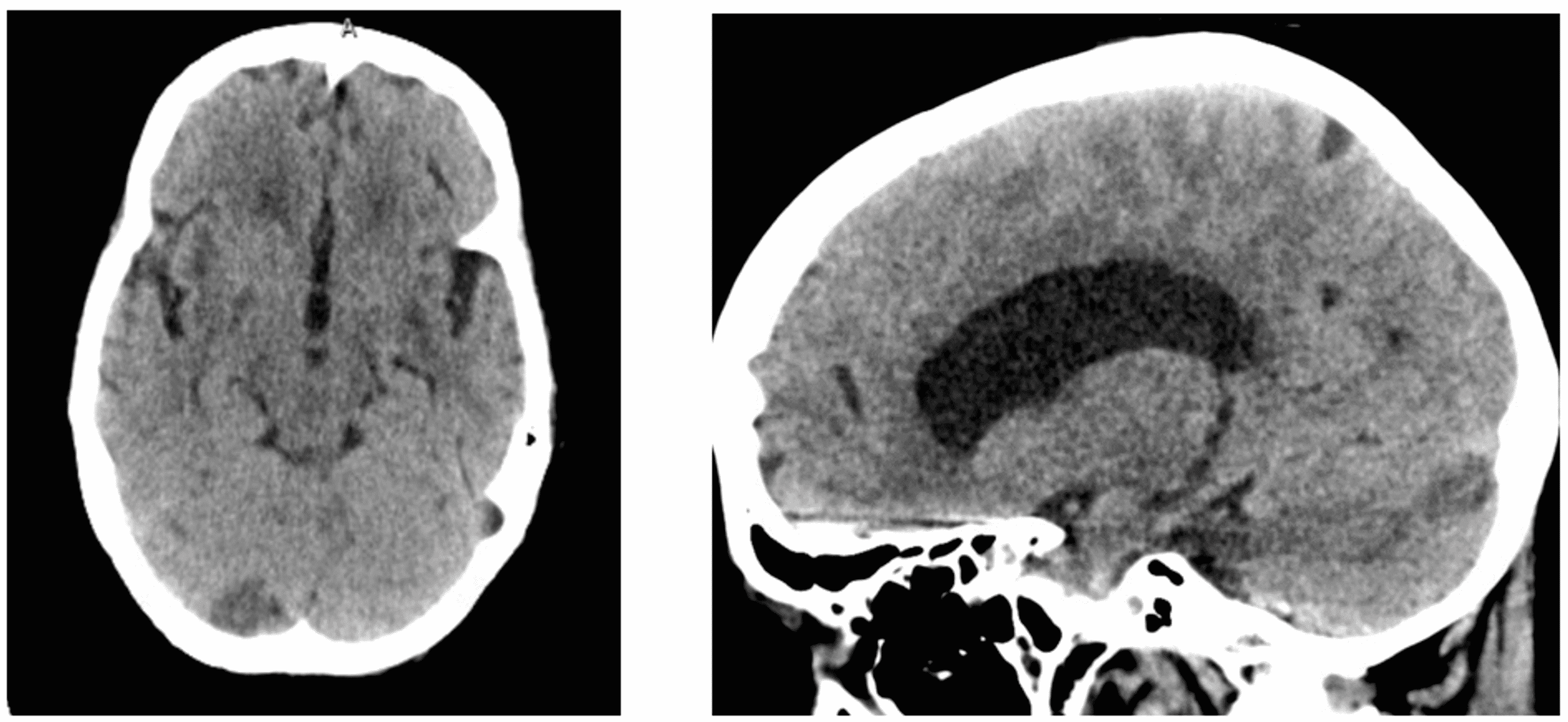 Cryptococcus Infection in an Immunocompetent Patient | Cureus