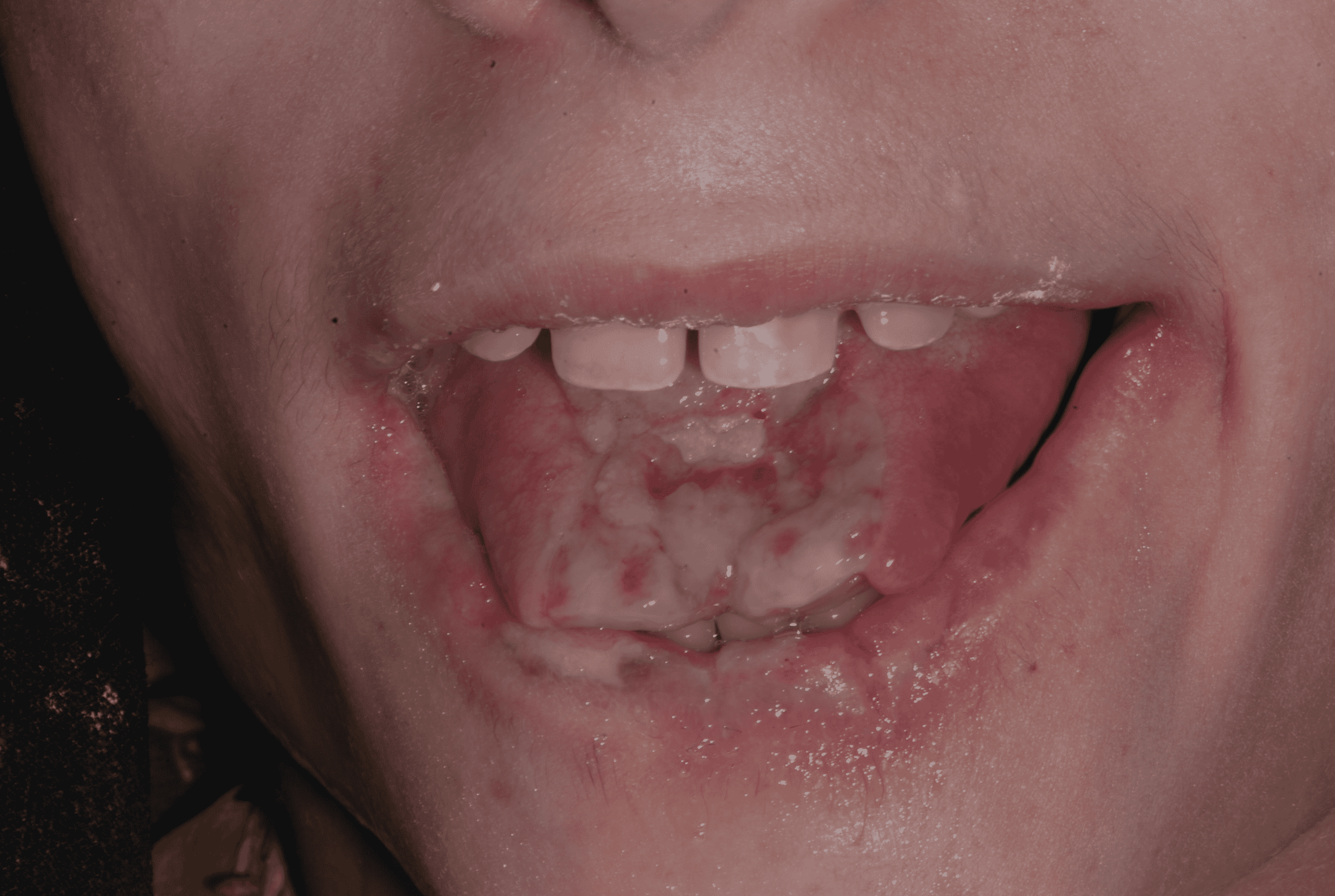 cureus-oral-self-mutilation-in-lesch-nyhan-syndrome-a-case-report