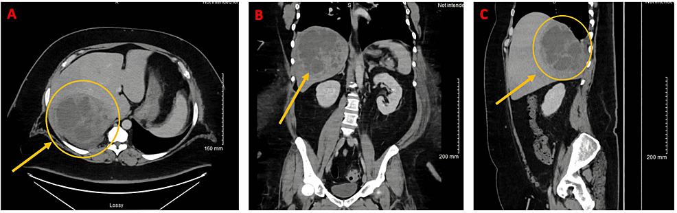 CT-of-the-abdomen/pelvis-with-contrast-on-hospital-day-five-(first-admission)